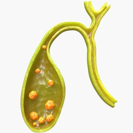 Vesicula Colelitiasis Cirugía en Texcoco